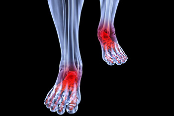 Arthritic foot and ankle care treatment in the Wheeling, IL 60090 and Chicago, IL 60613 area
