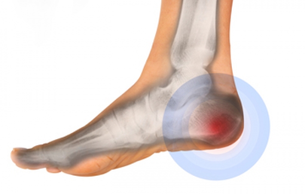 Is my heel pain from plantar fasciitis? | Gundersen Health