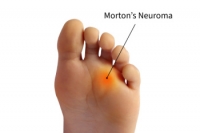 What Is Morton’s Neuroma?