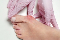 All About Bunion Surgery