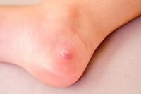 Foot Blisters and How to Prevent Them