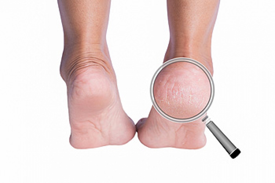 Cracked Heels: Causes, Symptoms & Treatment - The Foot Hub