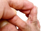 Athlete's Foot and and Why It Reoccurs