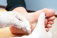 Managing Plantar Warts