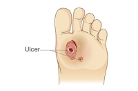 Causes and Care of Diabetic Foot Ulcers