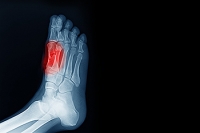 Sesamoiditis: A Sports Injury That Affects the Ball of the Foot